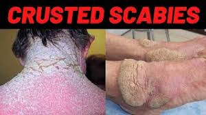 Image result for scabies norvegica