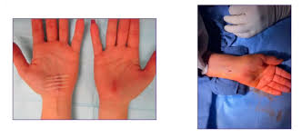 Image result for Carpal Compression Test