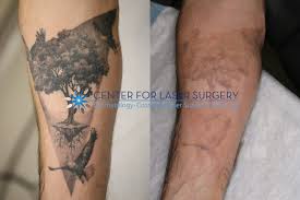 Tattoo Removal Washington Dc Center For Laser Surgery