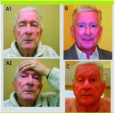 Myasthenia gravis (mg) je autoimunitní onemocnění postihující nervosvalový přenos. Myasthenie Grave Traitements Et Remissions