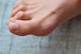 Image result for Hammer toe