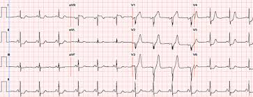 Mit begeisterung präsentieren wir eine neue serie: The De Winter Electrocardiographic Pattern Of Proximal Left Anterior Descending Coronary Artery Occlusion Sciencedirect