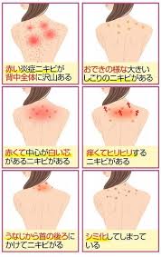 背中のニキビ 主な原因とおススメのスキンケア セレブスタイルジャパン ニキビケア ニキビ 背中ニキビ
