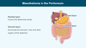 The first case was described in 1979 by mennemeyer and smith  1 . Peritoneal Mesothelioma Cancer Survival Rate How To Hindi