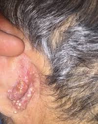 Rapidly is a derived term of rapid. Rapidly Growing Retroauricular Tumor Mdedge Dermatology