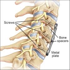 These spine surgeries are performed by highly qualified neurosurgeons lumbar fusion is a surgical procedure in which two or more vertebrae are fused in the lumbar region of spine. What To Expect From Acdf Surgery Recovery
