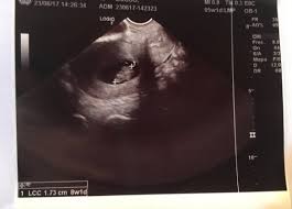 Mi Primera Ecografia 8 Semanas Embarazadas Primerizas Babycenter