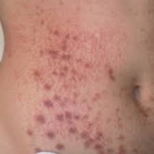 $$ skin care, medical spas, cosmetics & beauty supply. What Do I Do For Hyperpigmentation After Laser Hair Removal