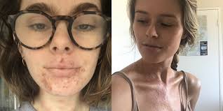 Check spelling or type a new query. 9 People Describe What Their Eczema Symptoms Are Really Like Self