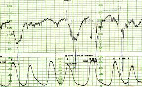 Image result for Late Deceleration