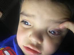 What could be causing my goldfish's cloudy eye?