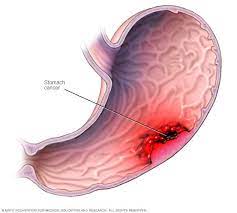 Growth of abnormal cells (tumour) affecting the organs in the abdominal cavity; Stomach Cancer Symptoms And Causes Mayo Clinic