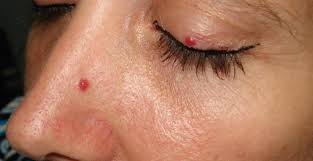 On 28 jan 2012 at 10:57 pm. Cherry Angioma Warrenton Dermatology Skin Therapy Center Board Certified Dermatologists