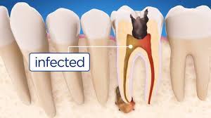 Jul 13, 2021 · the average cost for an incisor varies between $500 to $1,000. When Do You Need A Root Canal Treatment Procedure Step By Step