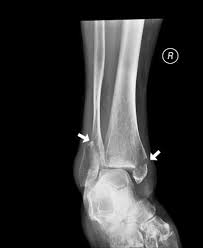 Torsion fracture) is a bone fracture occurring when torque (a rotating force) is applied along the axis of a bone. Image Spiral Fracture Of The Ankle Msd Manual Professional Edition