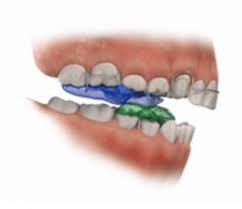 This is something you want to avoid doing with braces. What Is A Bite Block Appliance In Orthodontics Archwired