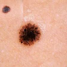 Image result for Spitz Nevus