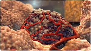 In some cases, the tumor can have features. What Is Tumorigenesis