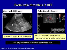 Doppler Ultrasound Of The Portal System Pathological Findings Ultrasound Vein Thrombosis Portal System
