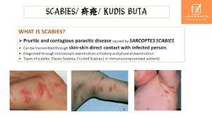 Kudis buta ataupun lebih dikenali sebagai scabies, merupakan sejenis penyakit kulityang mudah berjangkit. Scabies ç–¥ç–® Kudis 93è—¥å¸«çš„éšæ‰‹æ—¥è®° Pharmacist 93 Facebook