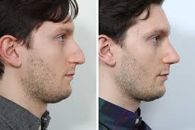 This is your ultimate guide to the best short haircuts for men. Rhinoplasty For Men Dr David Rosenberg