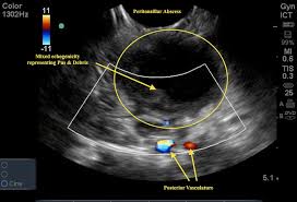 Hence, an ultrasound examination does not provide sufficient information to determine whether a nodule is benign or malignant. Sore Throat Emory School Of Medicine