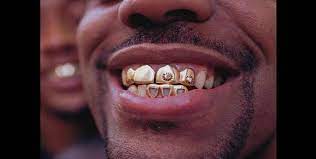 Find dentist in las vegas nv. Man Assaulted Robbed Of Gold Teeth In Sf S Financial District