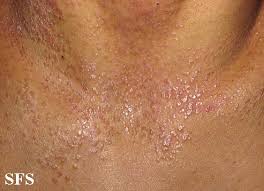 Check spelling or type a new query. Pityriasis Rubra Pilaris Wikidoc