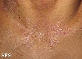 Medically reviewed by alana biggers, m.d., mph. Pityriasis Rubra Pilaris Wikidoc
