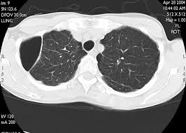 Image result for Pneumothorax