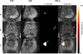 Despite this, pancreatic cancer is among the deadliest types of cancer, which is why it's extremely important to know and recogni. Voxel Level Classification Of Prostate Cancer Using A Four Compartment Restriction Spectrum Imaging Model Medrxiv