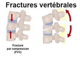 J'ai 5 vertebres de fixées dont la l1 de cassée par écrasement. Fracture Vertebrale Symptomes Traitement Definition Docteurclic Com
