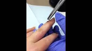 Mallet finger is the term applied to extensor avulsion fractures or distal extensor tendon ruptures. Pin Removal Post Mallet Finger Surgery Youtube