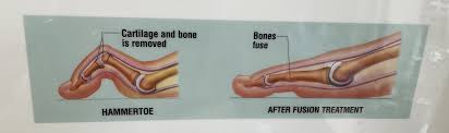 Image result for Hammer toe