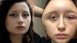 Yes, yes and yes again. Reaction To Ppd In Hair Dye Causes French Woman S Head To Swell Up Resembling A Light Bulb Latestly