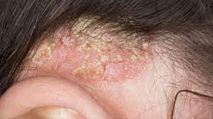 It can be very damaging to the skin it affects, but it very rarely metastasizes. Skin Cancer Acne Skin Injury Dermatology News Treatment Studies