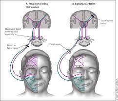 Bell S Palsy Diagnosis And Management American Family Physician