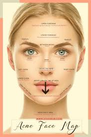 Get Rid Of Cheek Acne Acne On Nose Acne Face Chart Chin Acne Causes Acne And Pimples Appear In Some Other In 2020 Acne Face Chart Acne On Nose Face Mapping Acne