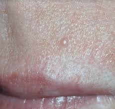 Any odd spot on your lip that does not go away should be shown to a doctor skilled in skin cancer. Suspicious Spot On My Lip Part 1 Skincancer Net