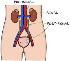 Image result for Postrenal Failure