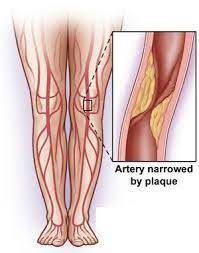 How To Know If Heavy Tired Legs Mean Heart Trouble Veins Treatment Heavy Legs Vein Specialist