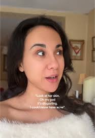 People with acne are trying their best 🫶