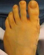 Operationen Des Hallux Valgus Dr Fecher