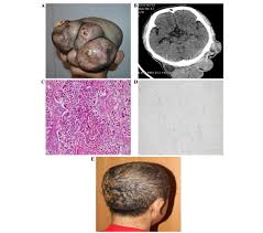 Tumor ae / tumour be . Surgical Treatment Of Rare Giant Malignant Tumors Of The Scalp A Report Of 3 Cases With Different Tumor Types