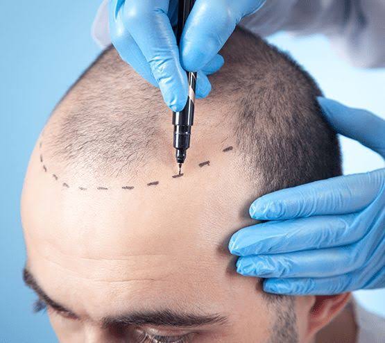 Hair Transplantation product image