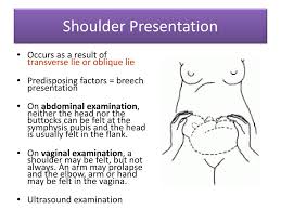 Image result for Shoulder Presentation