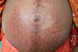Image result for pruritic urticarial papules and plaques of pregnancy