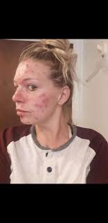 Recovery from addiction, 15 months clean and sober journey