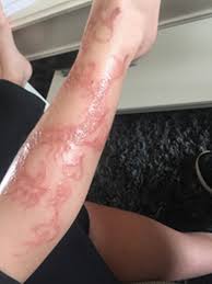 That's because the extra ingredient used to blacken. These Are The Hidden Dangers When Getting A Black Henna Tattoo Birmingham Live