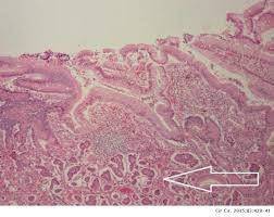 A lung carcinoid tumor is a type of cancerous tumor made up of neuroendocrine cells. Tumor Carcinoide Intestinal Reporte De Un Caso Cirugia Y Cirujanos